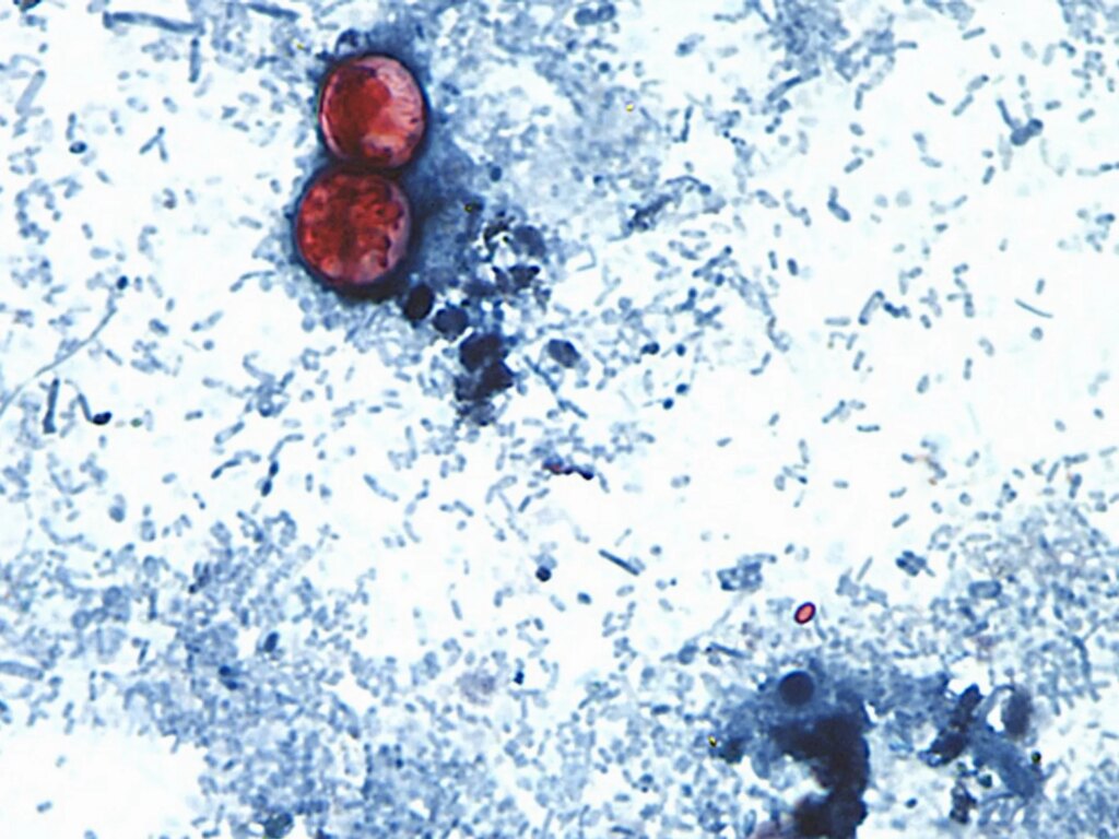 US announces first two deaths from cyclospora outbreak | Health News